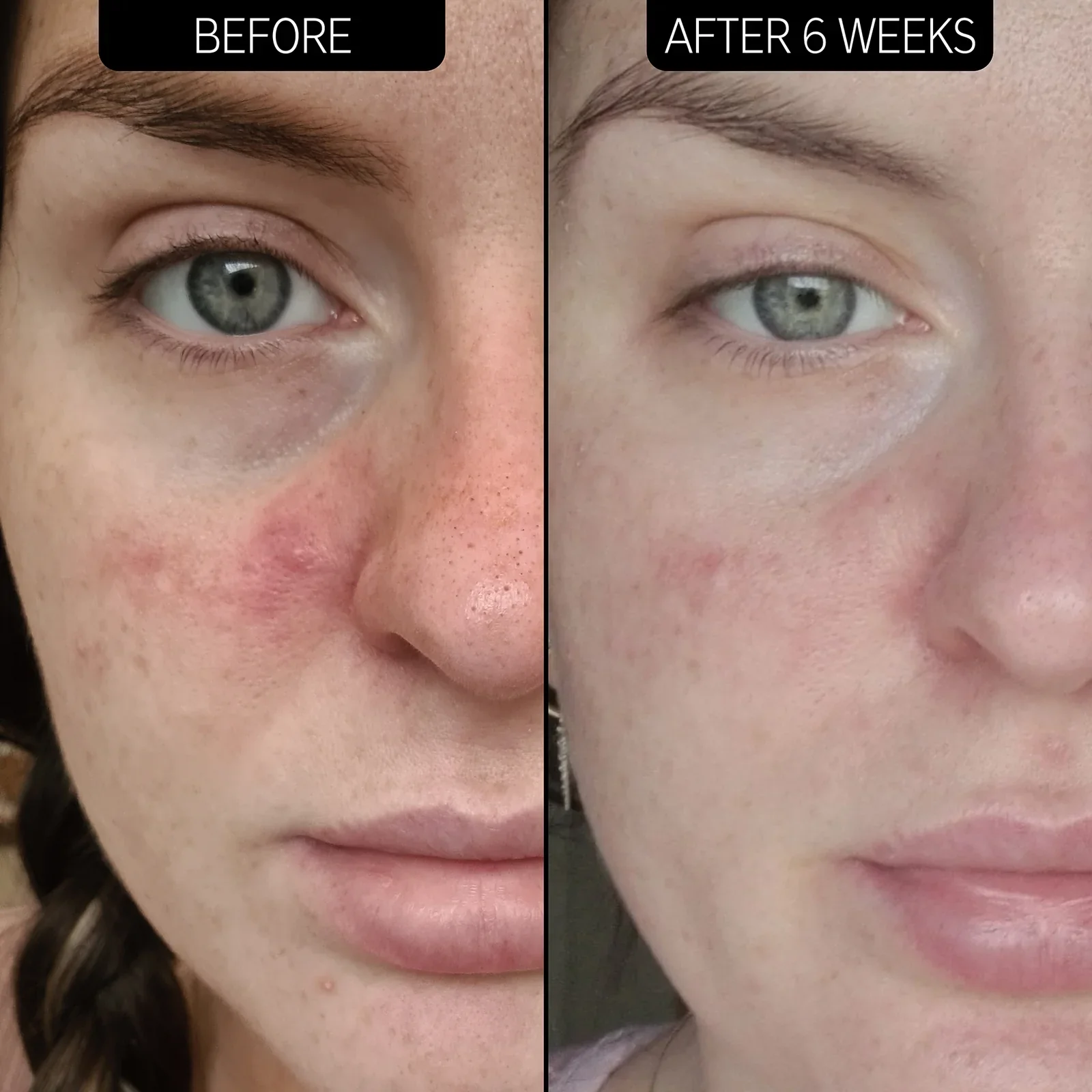 Azelaic Acid Serum 10% - Image 5