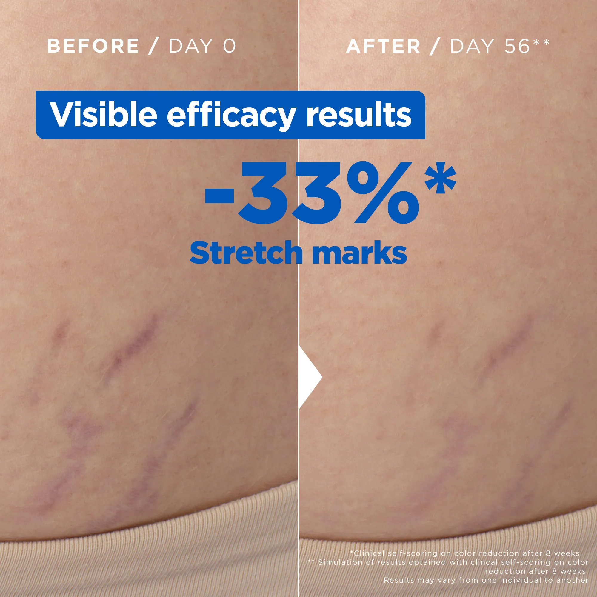 Anti Stretch Mark Oil - For Skin with Stretch Marks - With Omega 6 & 9 - Image 5