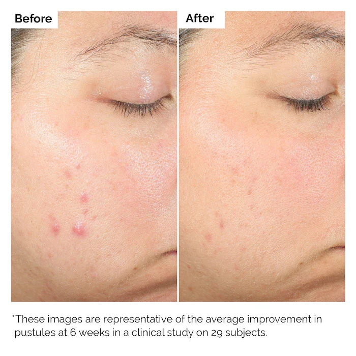 Salicylic Acid 2% Exfoliating Blemish Solution - Image 3